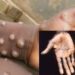 Fears As Monkeypox Resurgence Hits Africa