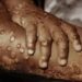 39 Cases Of Mpox Recorded In Nigeria With Zero Death-NCDC