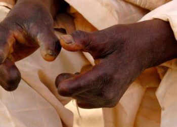 Relief As Nigeria Receives Leprosy Drugs After Year-Long Delay