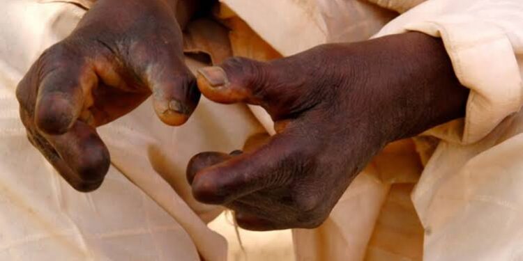 Relief As Nigeria Receives Leprosy Drugs After Year-Long Delay