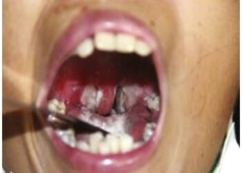 Diphtheria Outbreak Death Toll Reaches 1,319, Says NCDC