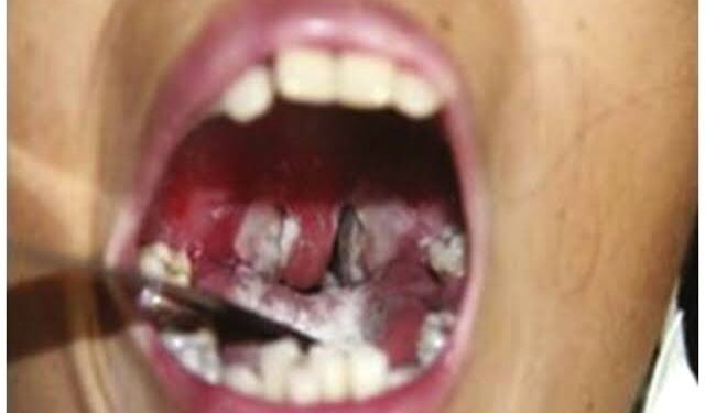 Diphtheria Outbreak Death Toll Reaches 1,319, Says NCDC