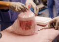 Pig Kidney Functions In Patient For Record 271 Days Before Being Replaced With Human Organ