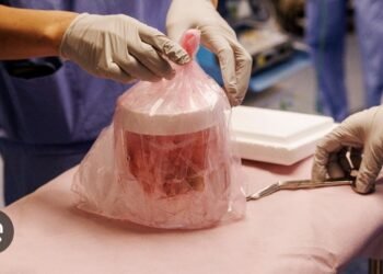 Pig Kidney Functions In Patient For Record 271 Days Before Being Replaced With Human Organ