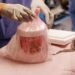 Pig Kidney Functions In Patient For Record 271 Days Before Being Replaced With Human Organ
